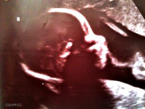 The Planned Parenthood videos talking about selling baby parts cause each of us to have a reaction, but what about the moms of those babies? We need to talk about them.